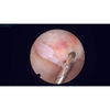 Arthroscope de 2,7 mm