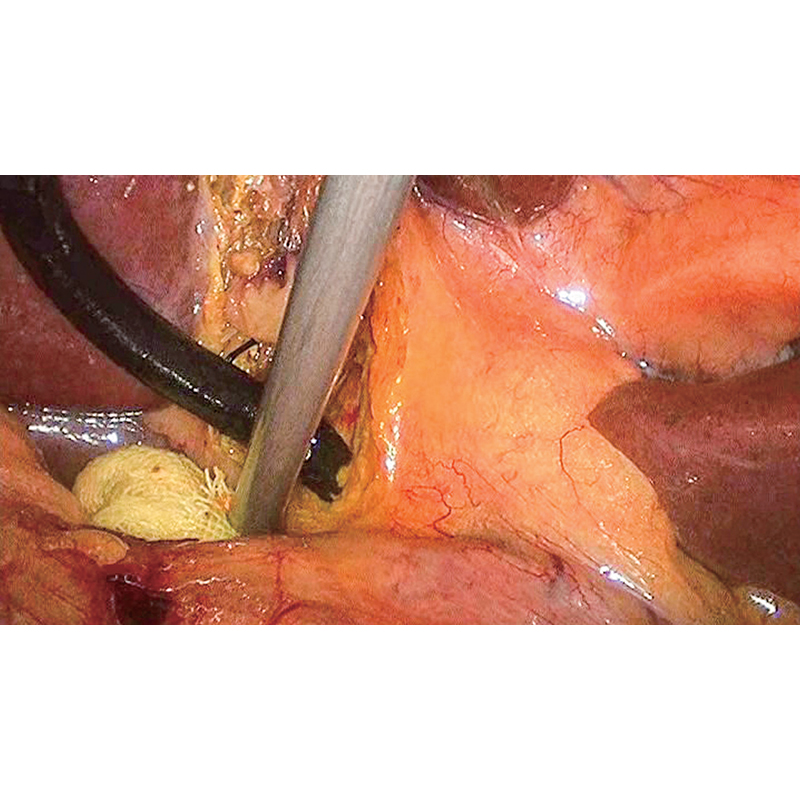 Laparoscope HD 10 mm 